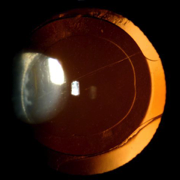 Kunstlinse (IOL) nach Cataract-Operation
